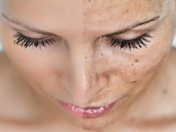 Preprost recept, kako odstraniti starostne pege